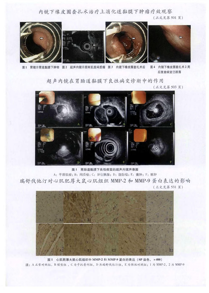 内镜下橡皮圈套扎术治疗上消化道黏膜下肿瘤疗效观察──附46例报告-图片-3.jpg